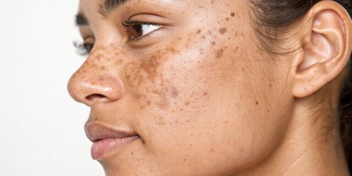 Dark Spot Correction Chevy Chase | Clear, Radiant Skin