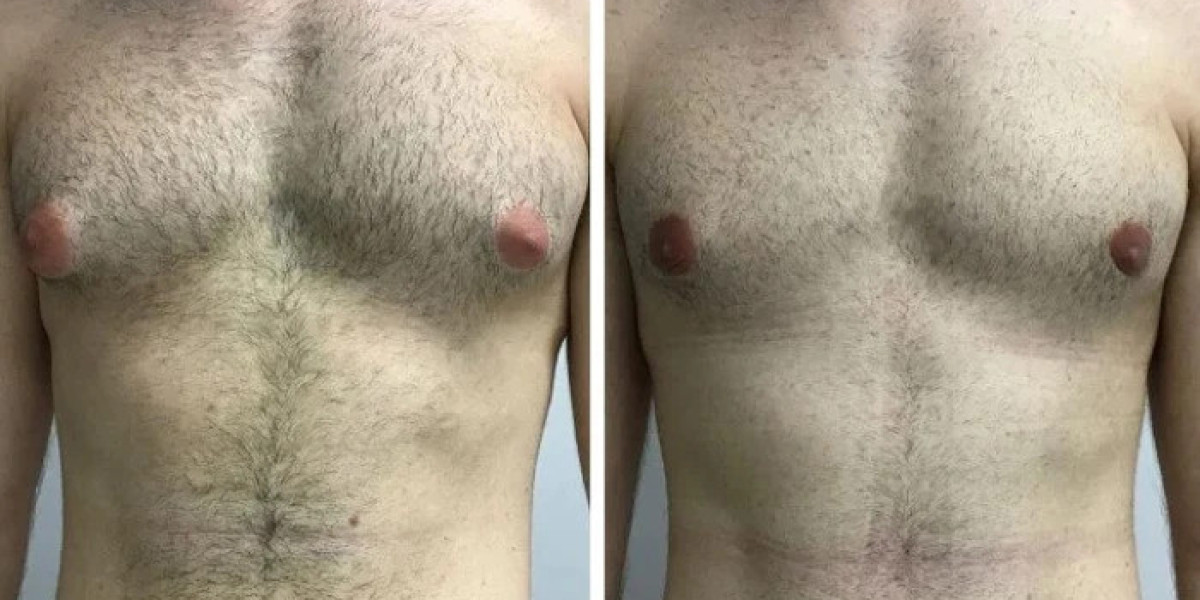 The Growing Popularity Best Gynecomastia Surgeons in Dubai Among Men
