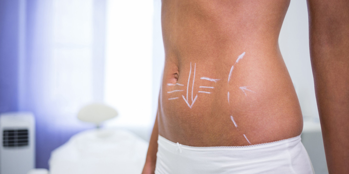 Mini Tummy Tuck Dubai: Benefits, Procedure, and Expected Results