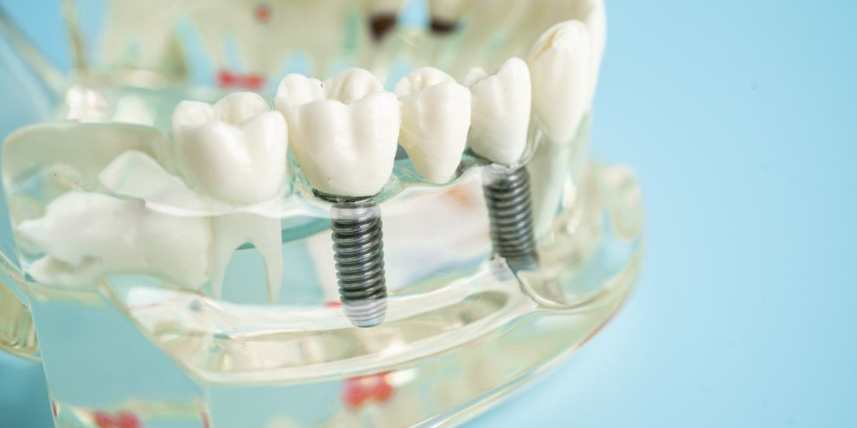 What Are the Signs You Need Dental Implants?