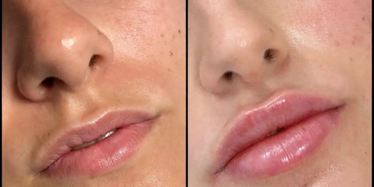 Fillers Treatment in Dubai for Balanced Facial Features
