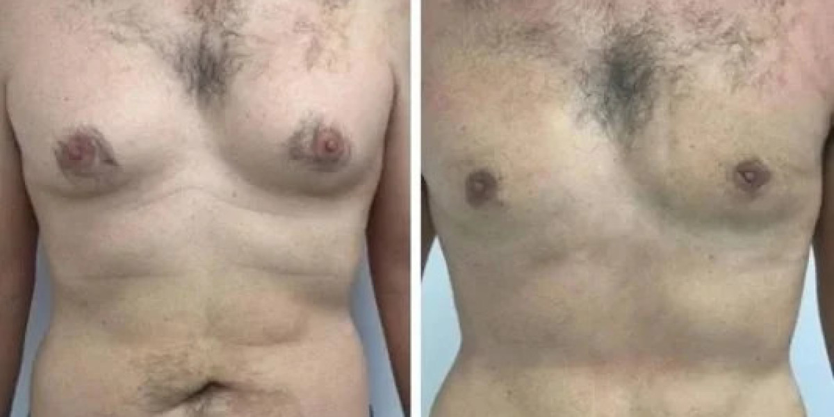 Gynecomastia Surgery in Dubai: Why Expertise Matters in Male Chest Contouring