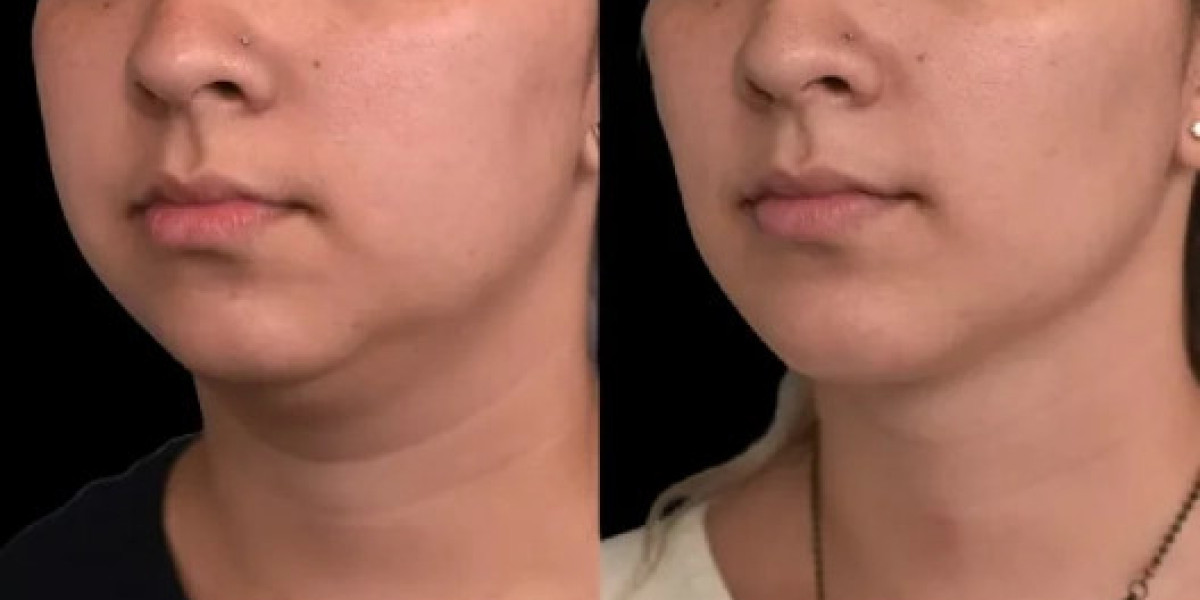 Best Double chin removal Surgeons in dubai Personalized Care