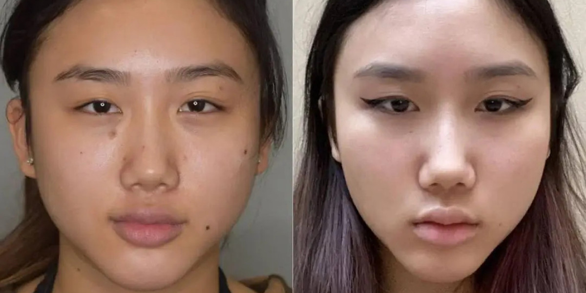 Best Buccal fat removal Surgeons in dubai ensure lasting beauty