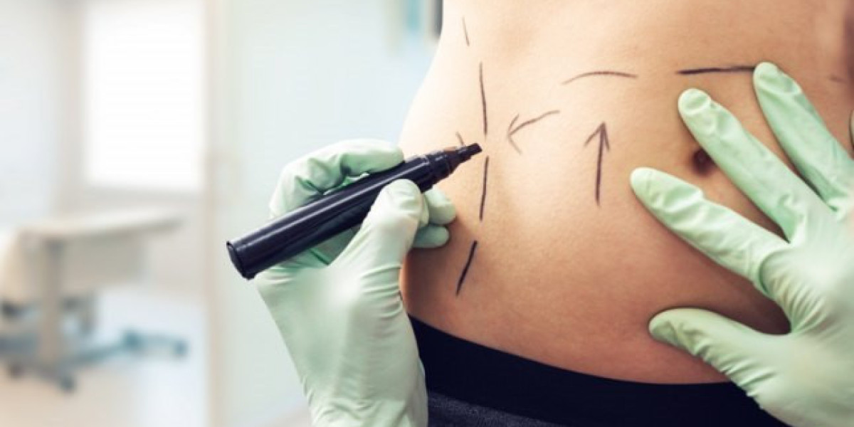 Liposuction in Islamabad: Understanding the Recovery Process Step by Step