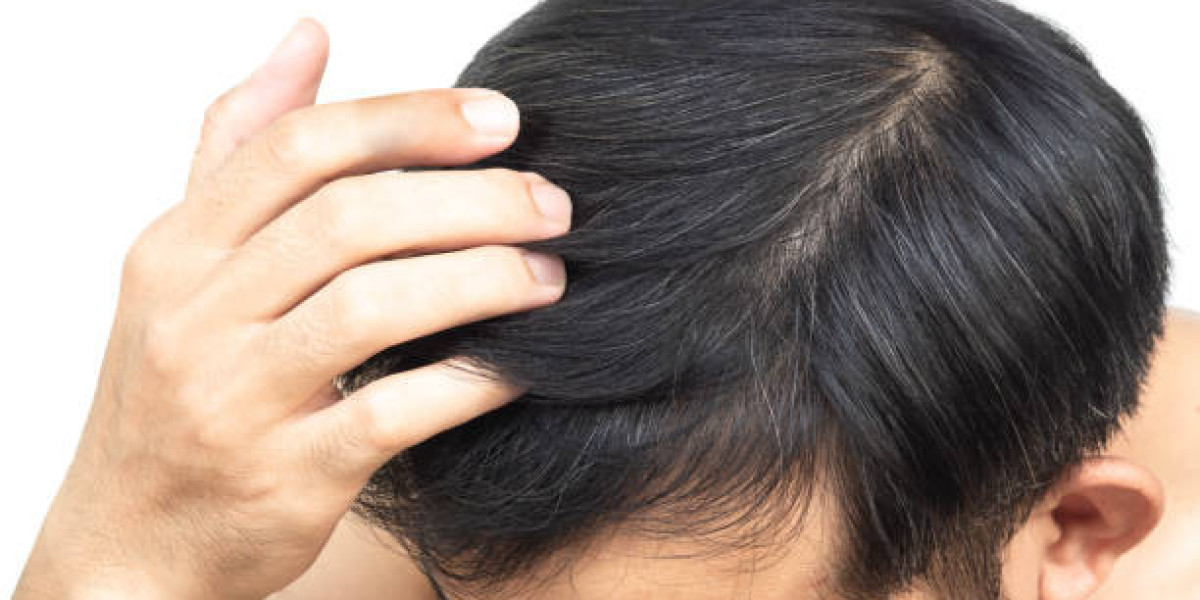 Exploring the Long-Term Benefits of PRP Hair Therapy
