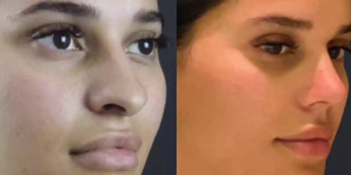 Can the Best Rhinoplasty Surgeon in Dubai Improve Nose Function?