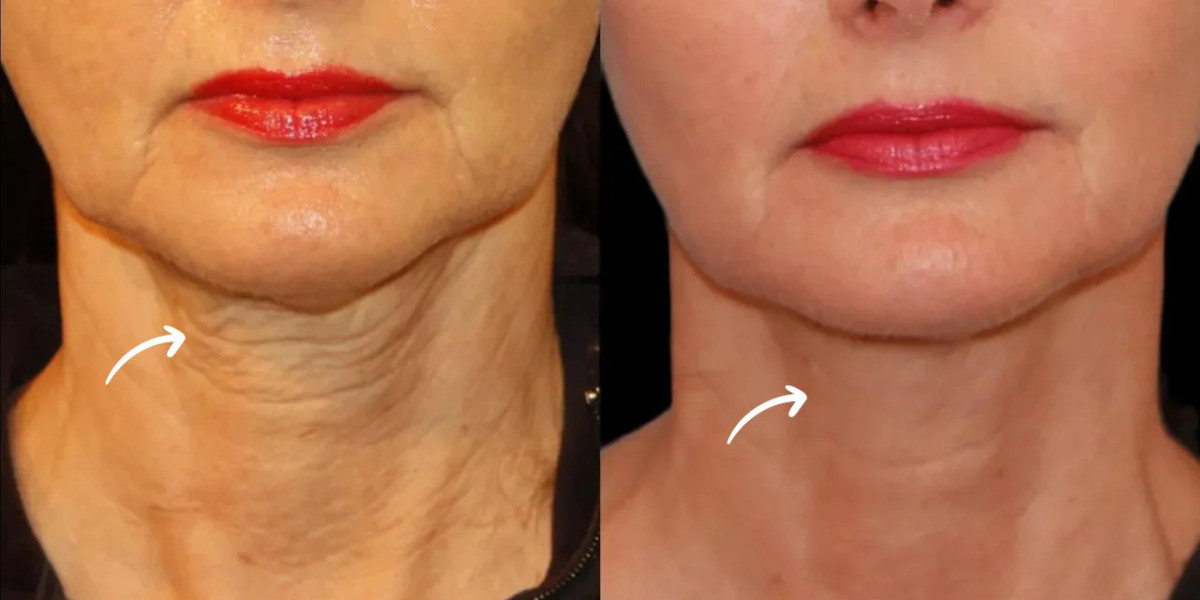 Best Doctors in Dubai Assess Sculptra for Lifestyle Based Goals